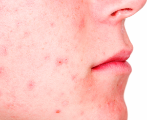 اسباب ظهور حب الشباب بالبشرة الدهنية وكيفية تجنبها