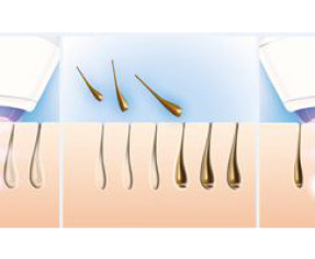 كم تكلفة ازالة الشعر بالليزر في السعودية ؟