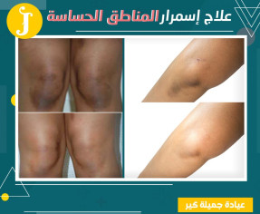 تفتيح المناطق الحساسة العلاج النهائي والفعال ومجرب من الكثير