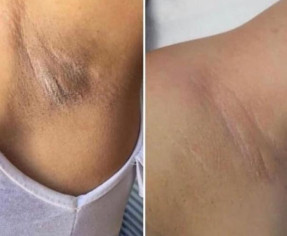 الطريقه الافضل للتخلص من الاماكن الداكنه في 22 يوم فقط