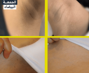 تفتيح المناطق الحساسة..أسرع واضمن علاج