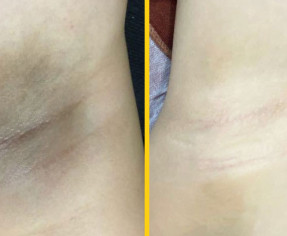 الطريقه الافضل للتخلص من الاماكن الداكنه في 22 يوم فقط