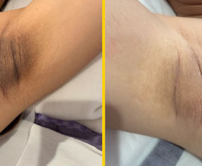 تفتيح المناطق الحساسة..أسرع واضمن علاج