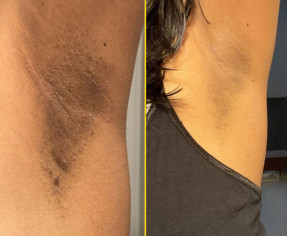 الطريقه الافضل للتخلص من الاماكن الداكنه في 22 يوم فقط