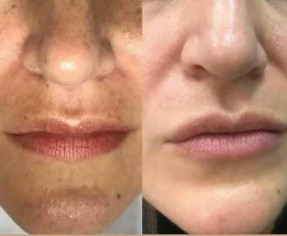 القضاء على التصبغات والكلف في أقل من شهر!