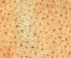 أفضل حل وعلاج نهائي لجلد الدجاجة