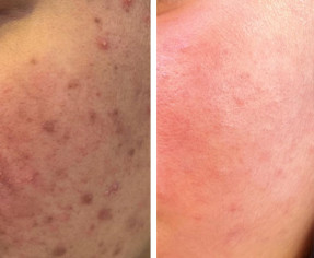 القضاء علي مشاكل و حبوب البشرة الدهنية في اقل من 20 يوم