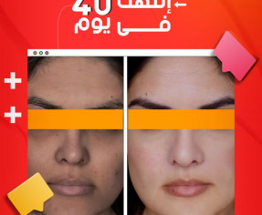 البرنامج الثلاثي المفعول للقضاء علي تصبغات و كلف البشرة في 30 يوم