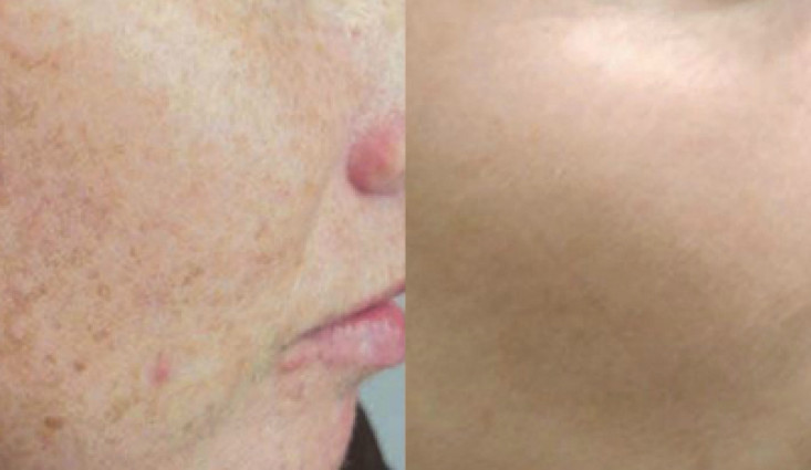 الليزر المنزلي للوجه – هل الليزر للوجه آمن أم ضار ؟