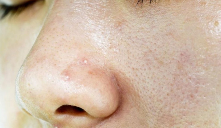 البشرة الدهنية ملف كامل – و افضل طرق علاجها