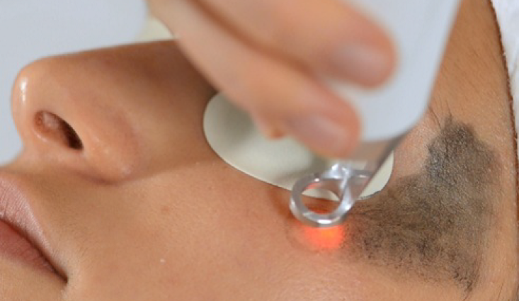 ما هي اضرار الليزر الكربوني للوجه ؟