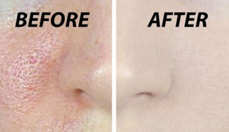 ليزر فراكشنال للمسامات | نتائجه و تكلفة الجلسات