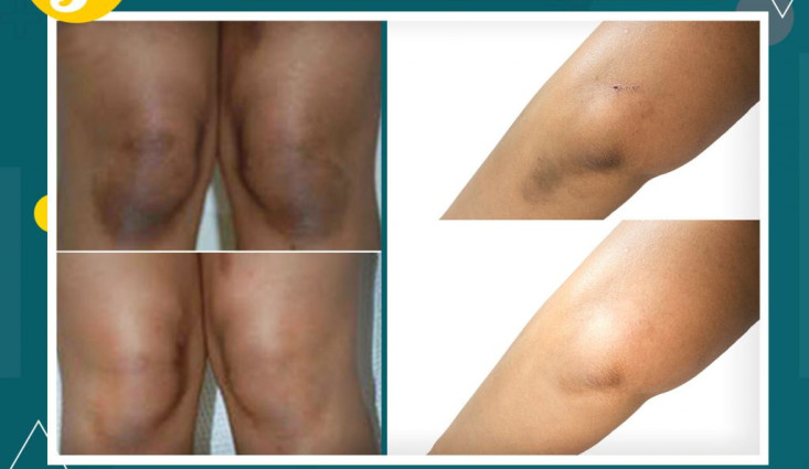 تفتيح المناطق الحساسة العلاج النهائي والفعال ومجرب من الكثير