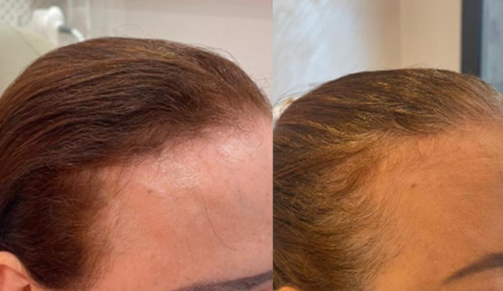 شعري رجع أفضل من قبل كأني زرعت شعر مررره رهيب الي سويته العلاجات