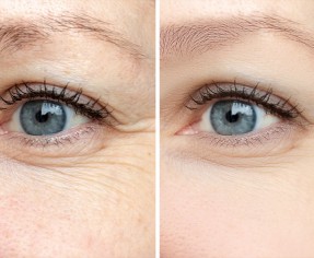 تجاعيد العين المبكرة في سن صغير | عوامل ظهورها و علاجها