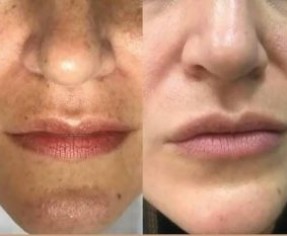 العلاج النهائي لتصبغات الوجه بلا راجعة (بدون آثار جانبية)