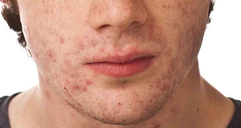 الرجال و السيدات و البشرة الدهنية ! Acne-treat-for-men