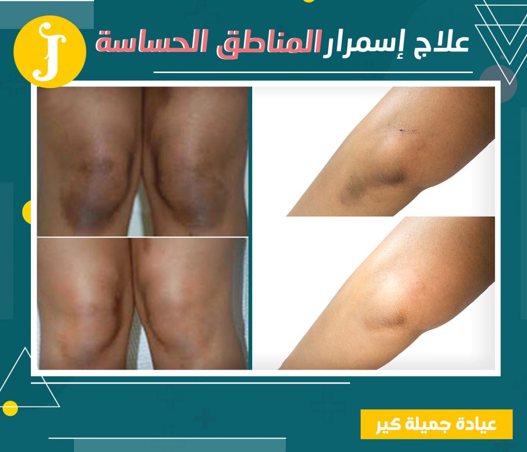 تفتيح المناطق الحساسة العلاج النهائي والفعال ومجرب من الكثير