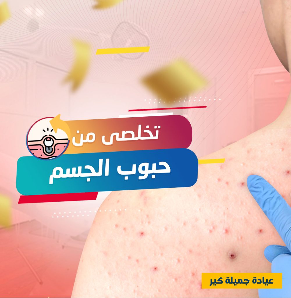كورس علاج حبوب الجسم عروض البلاك فرايداي