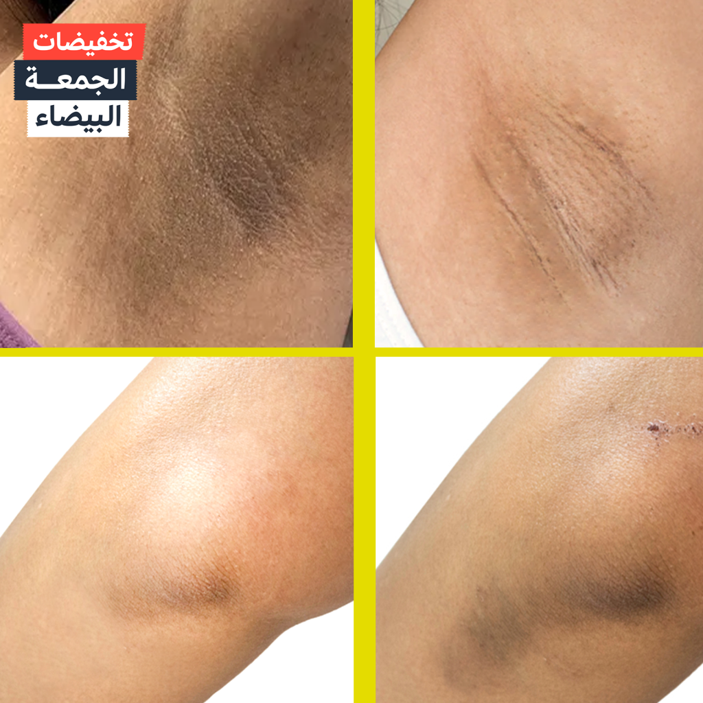 تفتيح لون الجسم كامل للعروس..في اسرع وقت