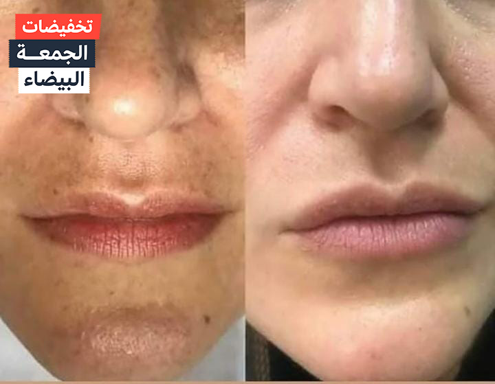 أفضل طريقه لتفتيح البشرة في 14 ايام فقط