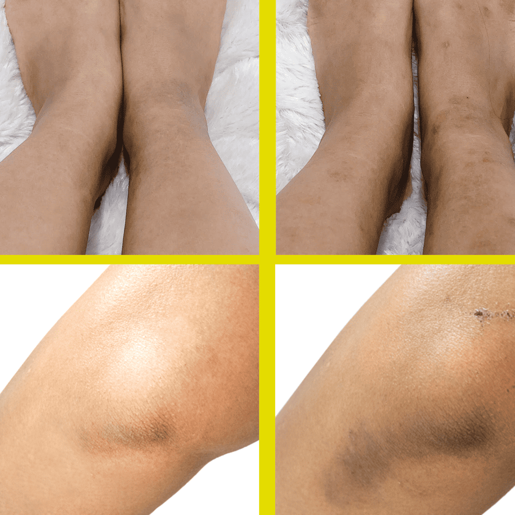 القضاء علي اسمرار و تصبغات الجسم في أسرع وقت و بأمن الطرق