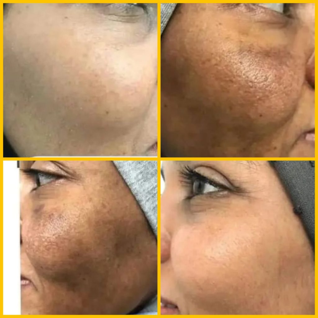 1000 حاله تخلصو من إسمرار وتصبغ الوجه مع البرنامج العلاجي المكثف