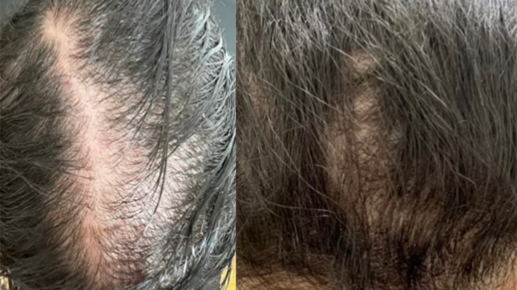 كيف يمكنك انبات اكثر من 5000 شعره بالشهر الواحد؟