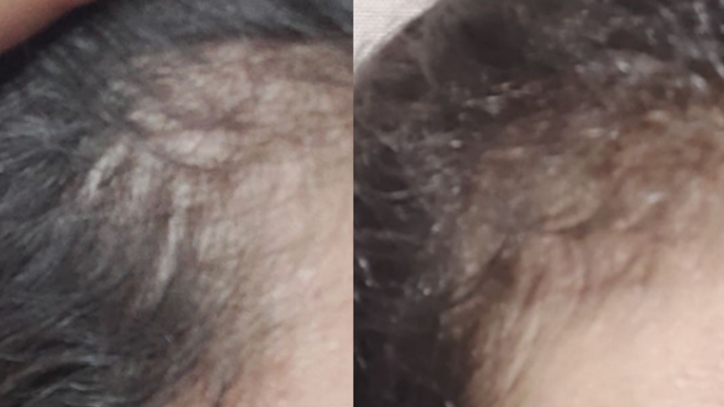 كيف تتخلصي من تساقط الشعر و الفراغات بأسرع وقت ممكن و بأقل تكلفة