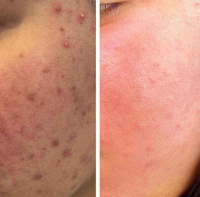 القضاء علي مشاكل و حبوب البشرة الدهنية في اقل من 20 يوم