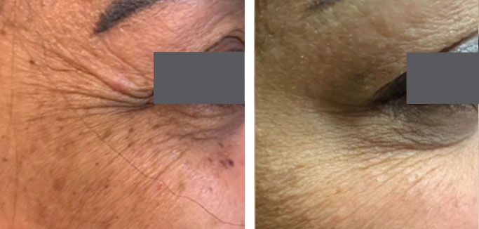 البديل العلاجي للفيلر للتخلص من التجاعيد و الخطوط بالوجه و الرقبة