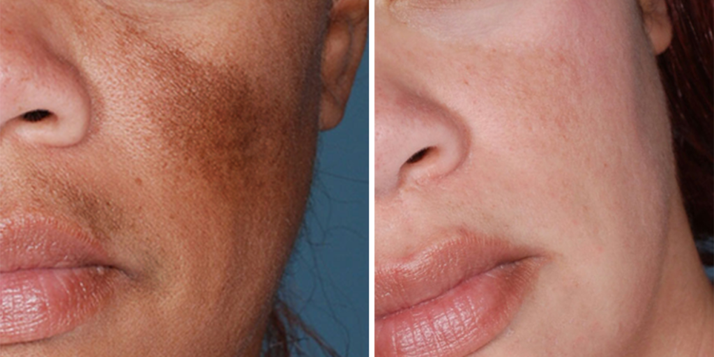 كيف تتخلصين من اسمرار و مشاكل البشرة تماماً بأقل من 45 يوم